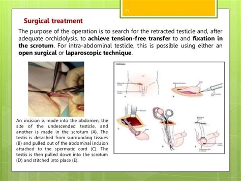 birthdefect where the testes fail to drop|undescended retractable testes.